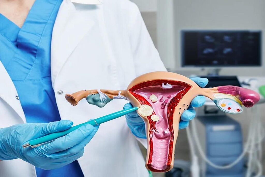Uterine Fibroids