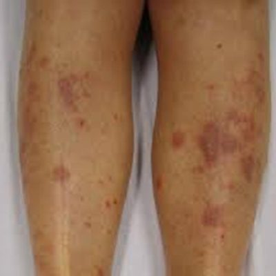6 Ideas on How to Get Rid of Eczema Scars on Legs