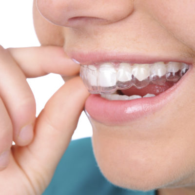 The Benefits Of Using Invisalign Braces To Get A Perfect Smile