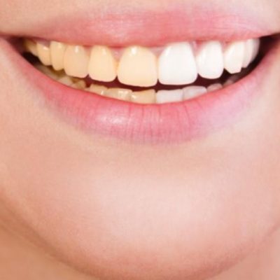 Are You Embarrassed Of Pale Yellow Teeth?